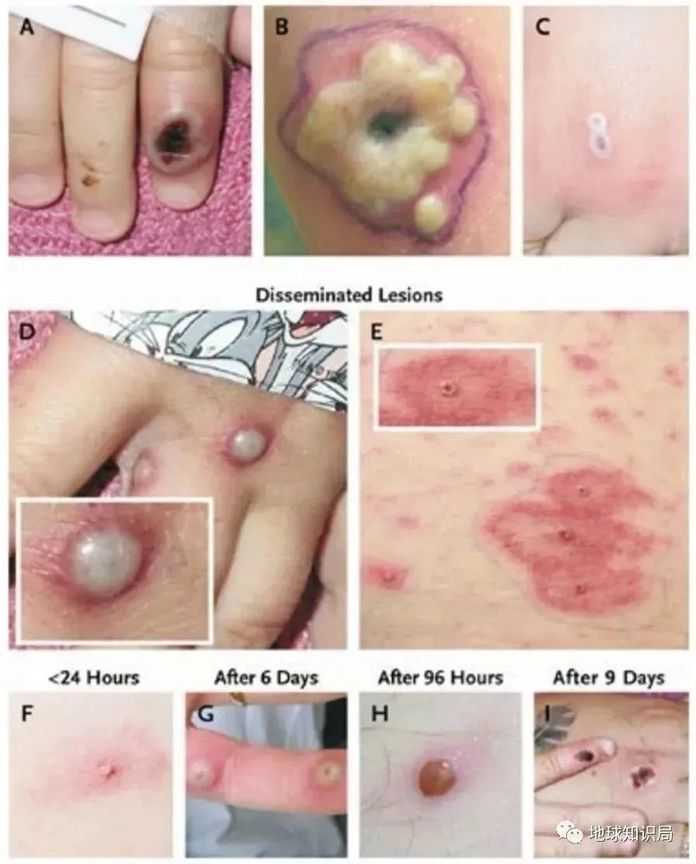 73b0190771f6b71eb6b5d83537c5ab24e6a87078 nejm.org & CDC)